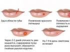 Причины и профилактика частого герпеса на губах
