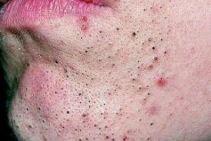How to quickly remove blackheads on the face at home - the best recipes and methods